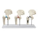 Erler-Zimmer Hüft-Implantat-Modell, 3 Teile